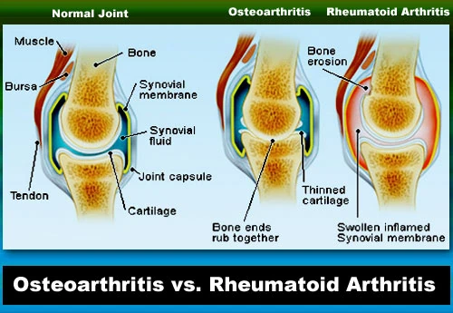 Osteoarthritis vs. Rheumatoid Arthritis Diagram Infographic