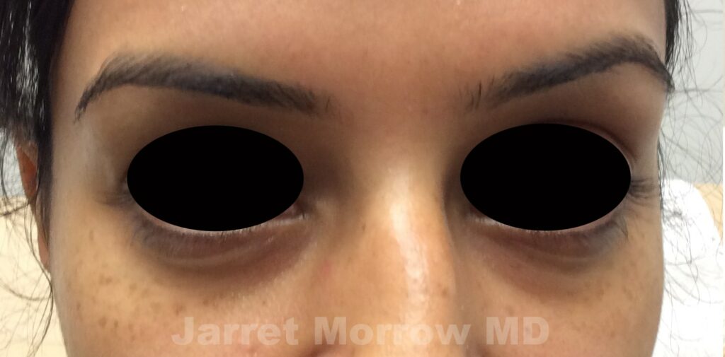 Before Restylane Dark Circles
