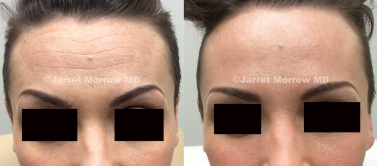 dysport before and after