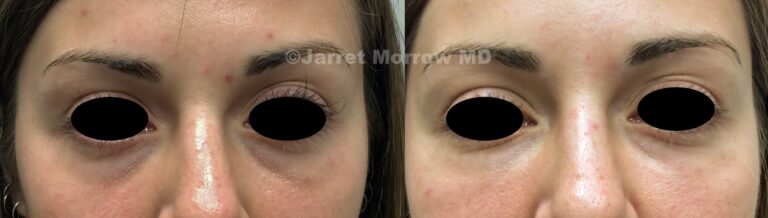 skinboosters before and after