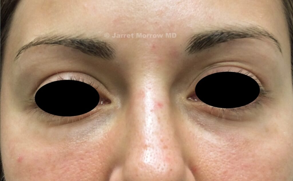 skinboosters after