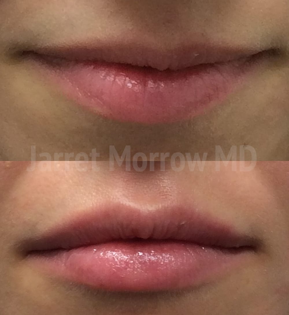 Restylane Edmonton before and after