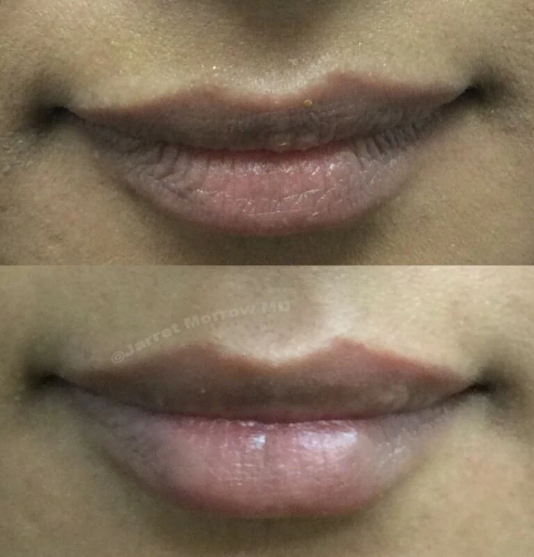 Lip Fillers Geelong Lip Injections & Augmentation Dr Morrow
