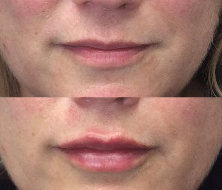 Lip Fillers Geelong Lip Injections & Augmentation Dr Morrow