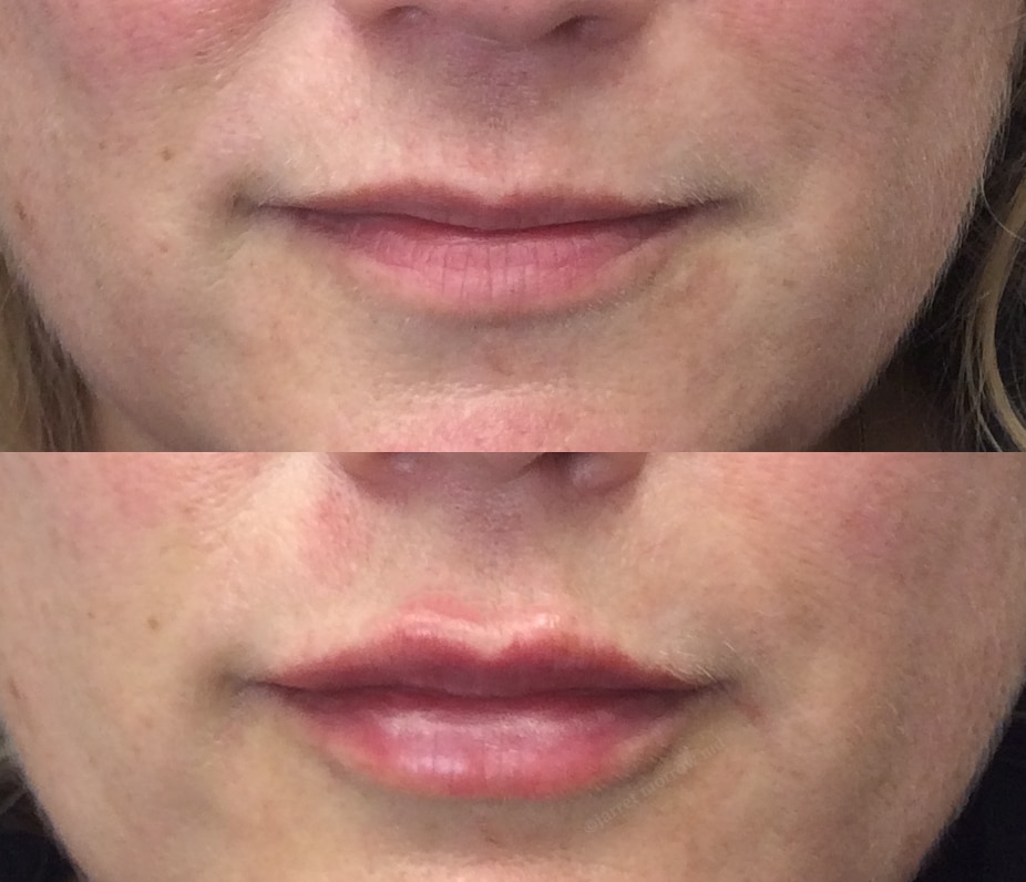 Restylane Kysse lips Before and After