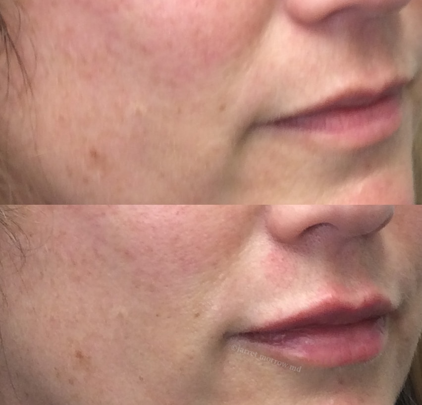 Restylane Kiss side before and after