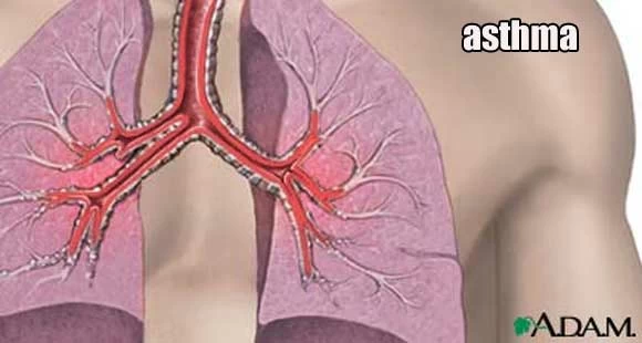 asthma