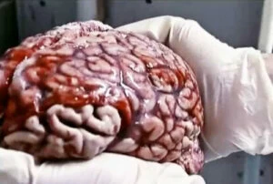 Albert Einstein's Brain Actual Photo