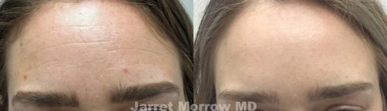 botox before and after