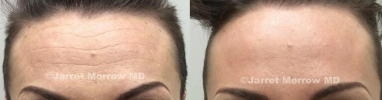 dysport before and after