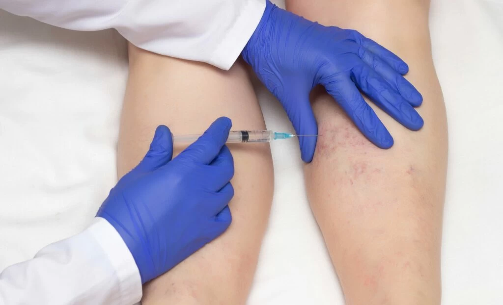 sclerotherapy edmonton