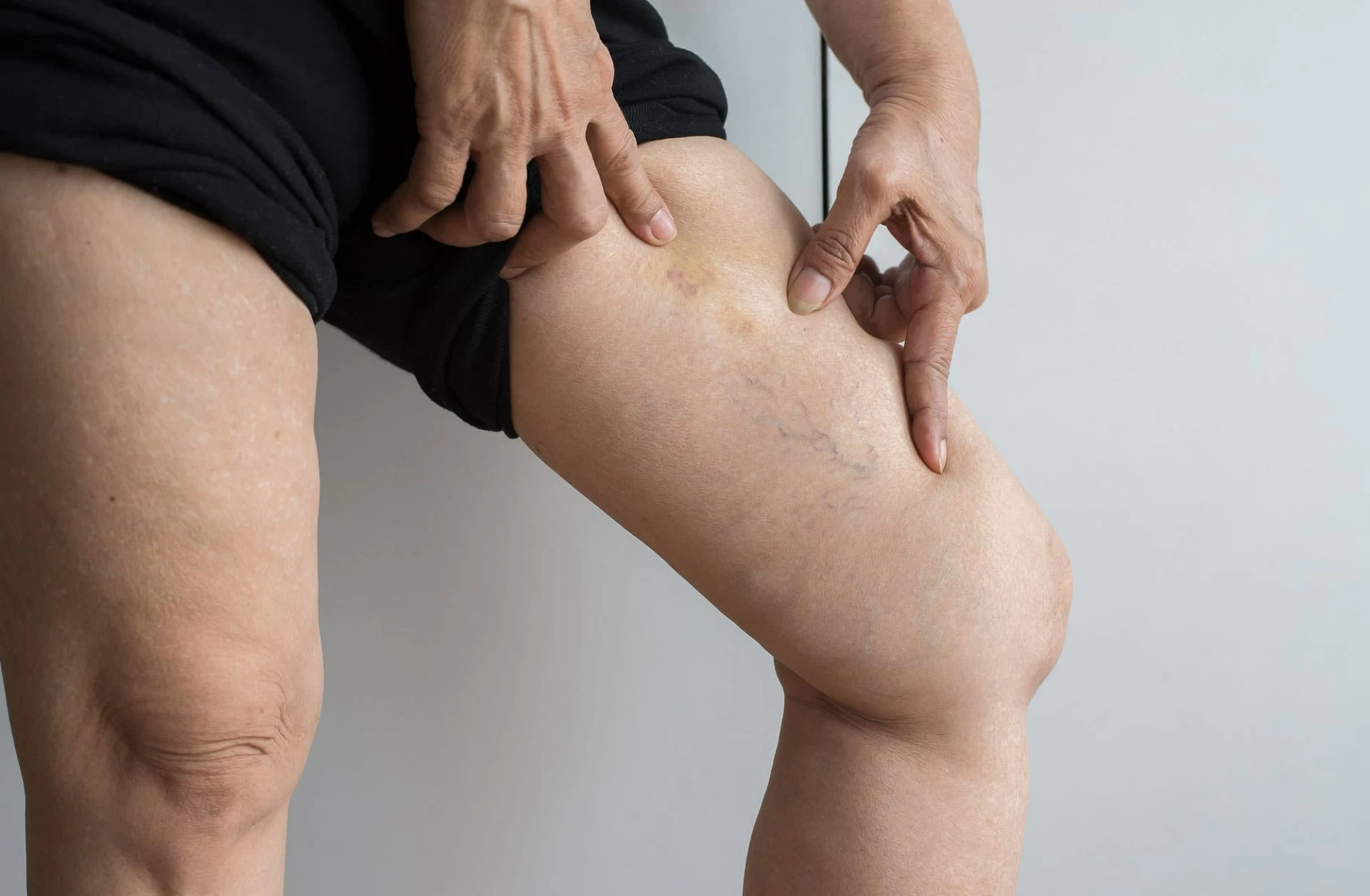 woman with varicose veins