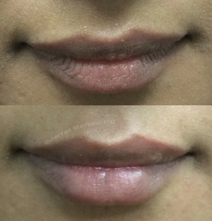0.5 cc Restylane Kysse Lip filler before and after photo